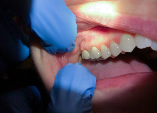 Best Emergency Treatment for Oral Infections in Pistakee Highlands, IL